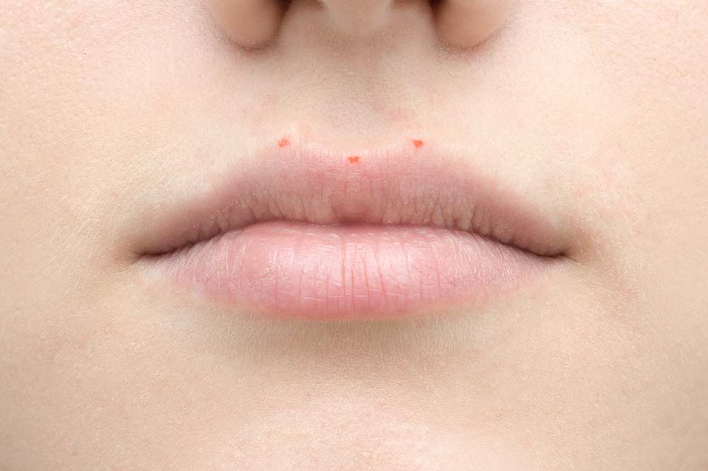 Неровный контур губ после перманентного макияжа